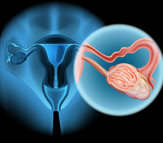 Ovarian Cancer